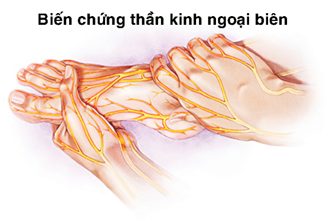 CÁC BIẾN CHỨNG CỦA BỆNH TIỂU ĐƯỜNG